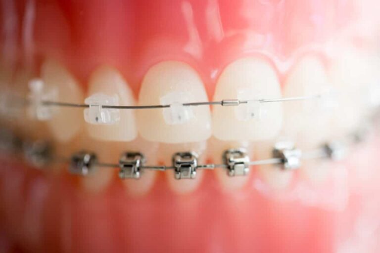 Stains on Clear Braces? How to Keep Them Clean Tupelo, MS